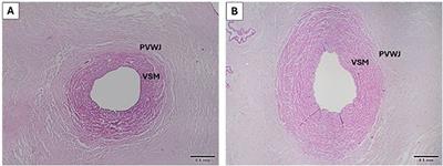 Umbilical vein remodeling is associated with pregestational maternal overweight